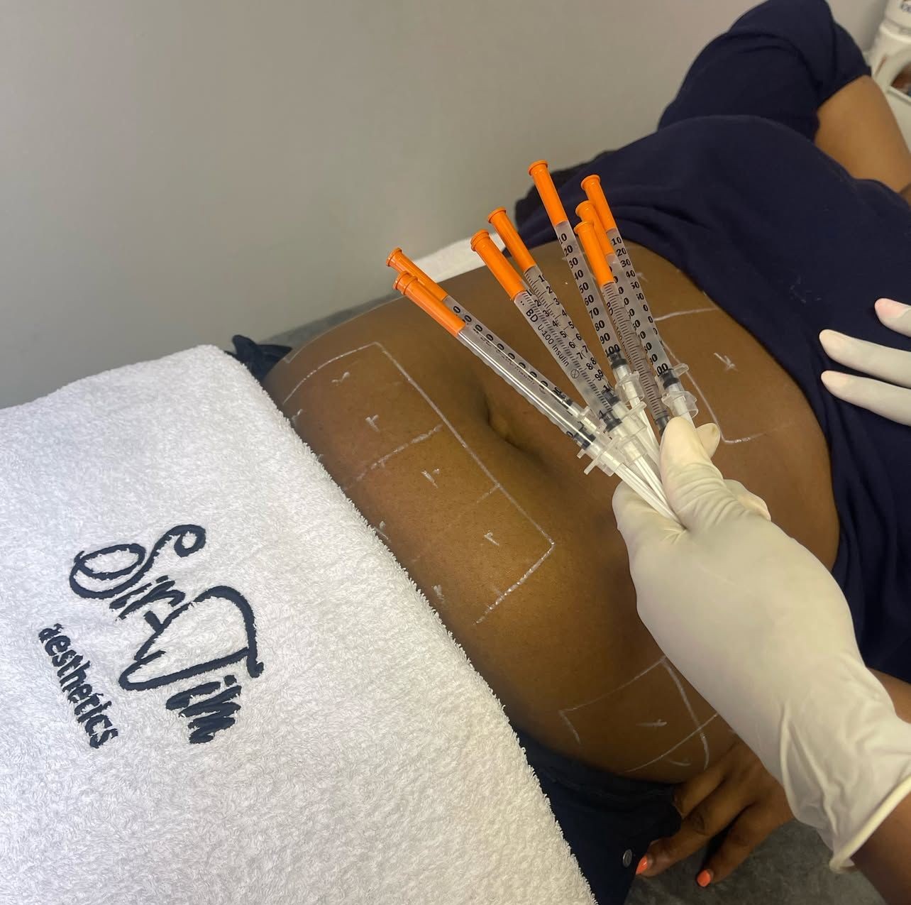 Person receiving aesthetic treatment with multiple syringes on marked abdominal area.